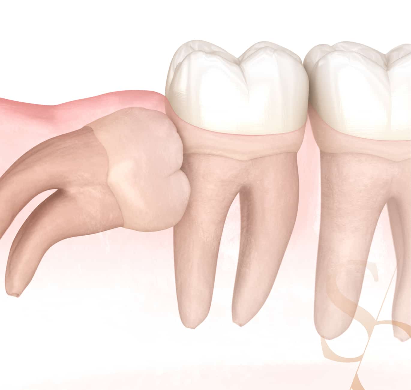 Limer les dent : le remodelage dentaire, Clinique Sana Oris