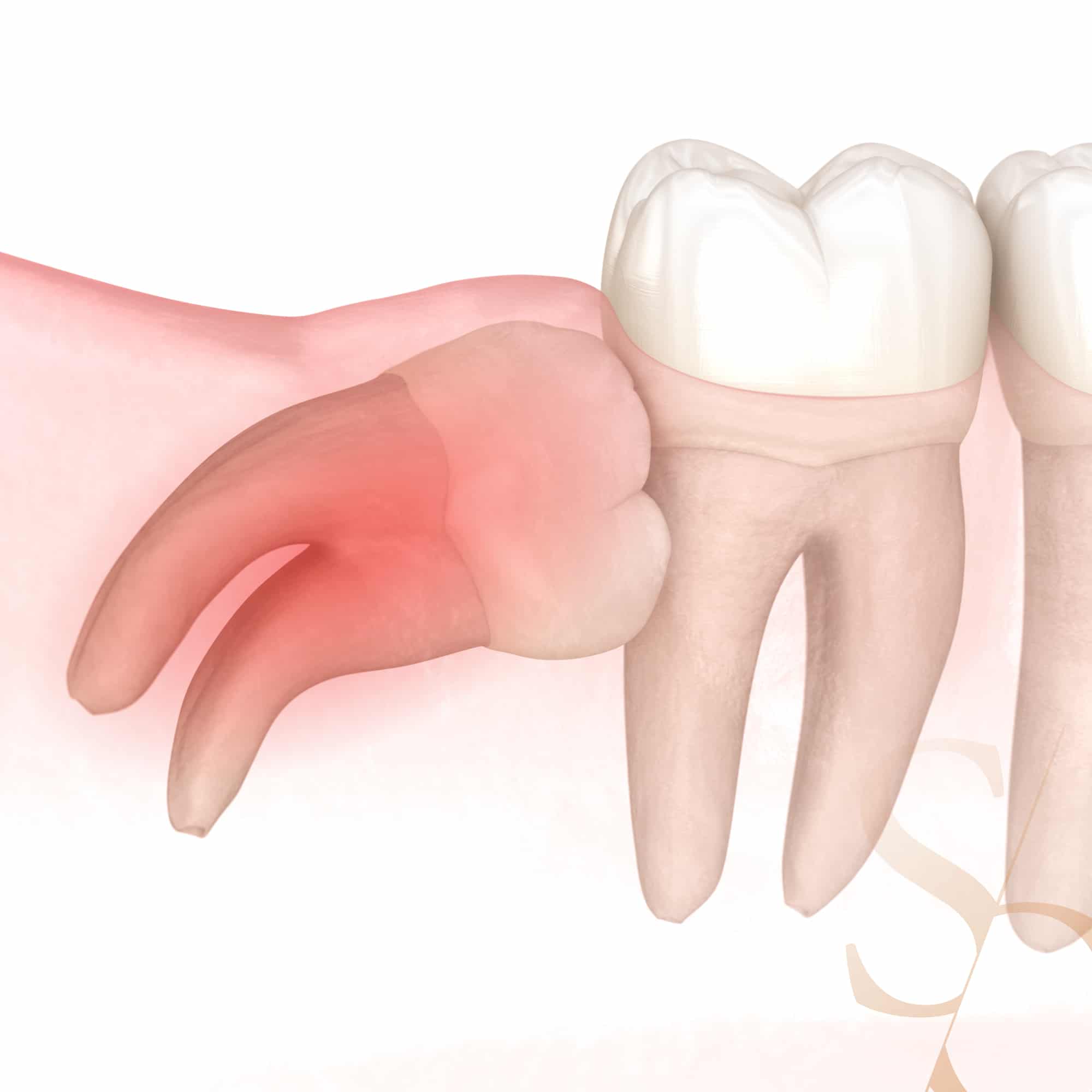 Extraction dents de sagesse | Intervention et informations | Clinique dentaire Sana Oris Paris 8