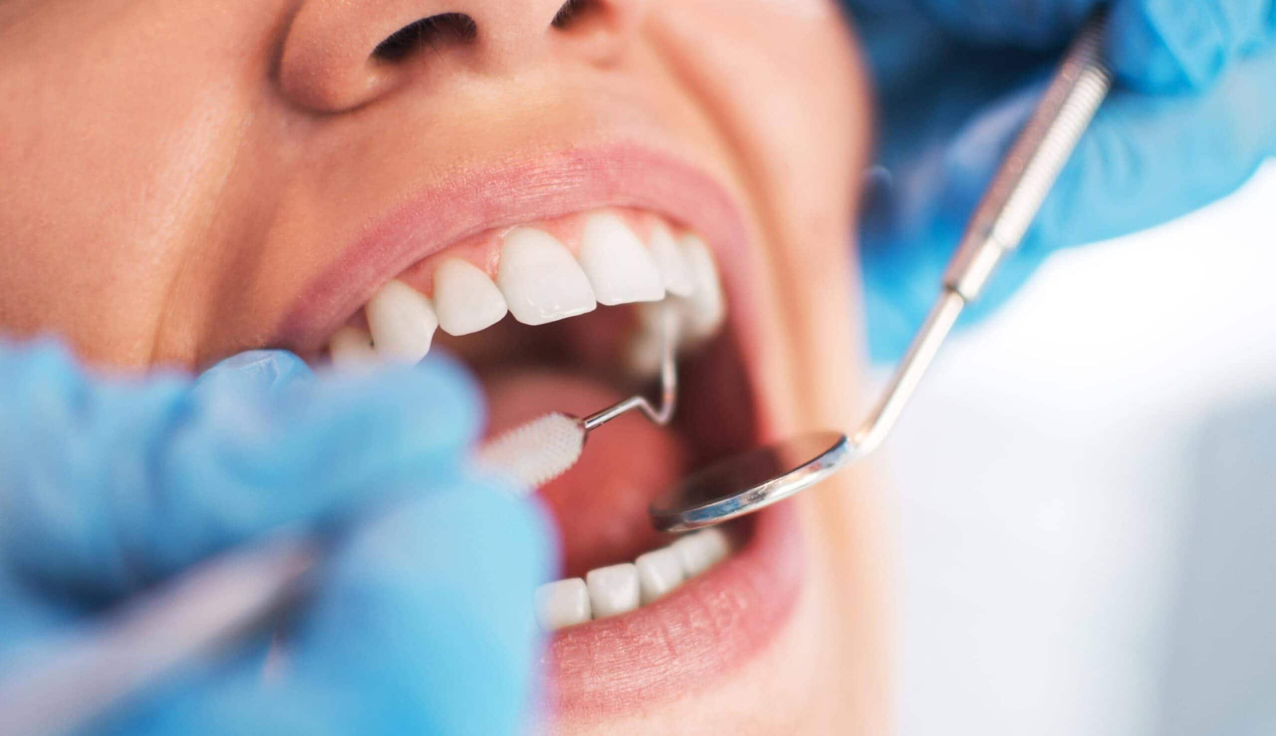Limer les dent : le remodelage dentaire, Clinique Sana Oris
