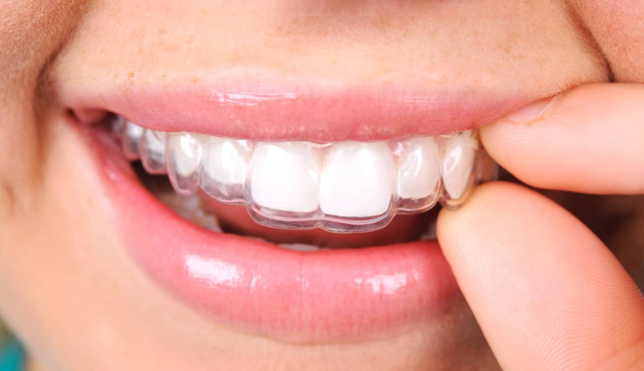 Quels appareils pour aligner ses dents ? | Clinique dentaire Sana Oris | Paris 8