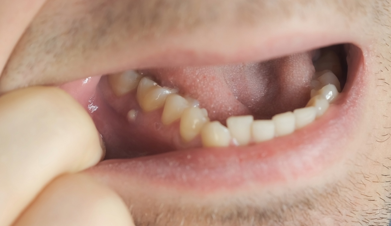 Quelles sont les causes possibles d’un abcès dentaire ? | Clinique dentaire Sana Oris | Paris 8