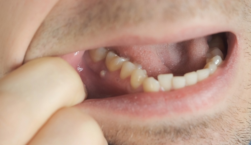 Quelles sont les causes possibles d’un abcès dentaire ? | Clinique dentaire Sana Oris | Paris 8