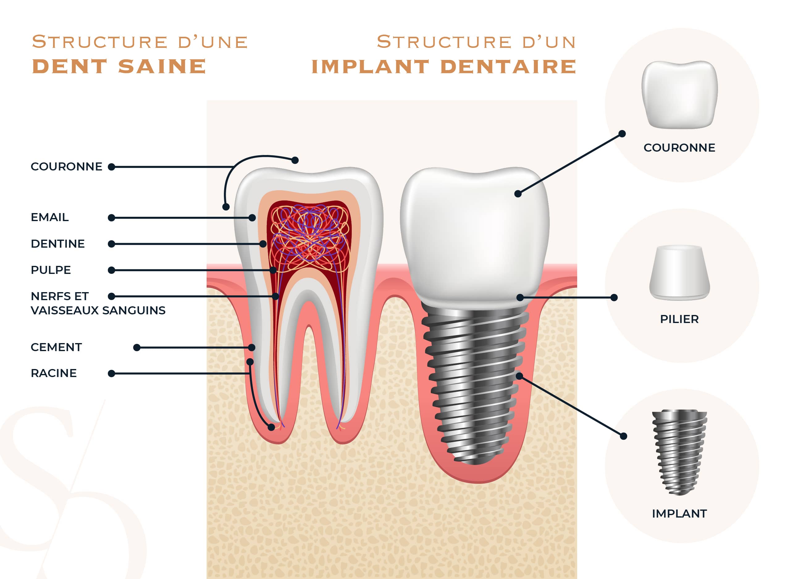 Structure d’une dent saine et d’un implant dentaire