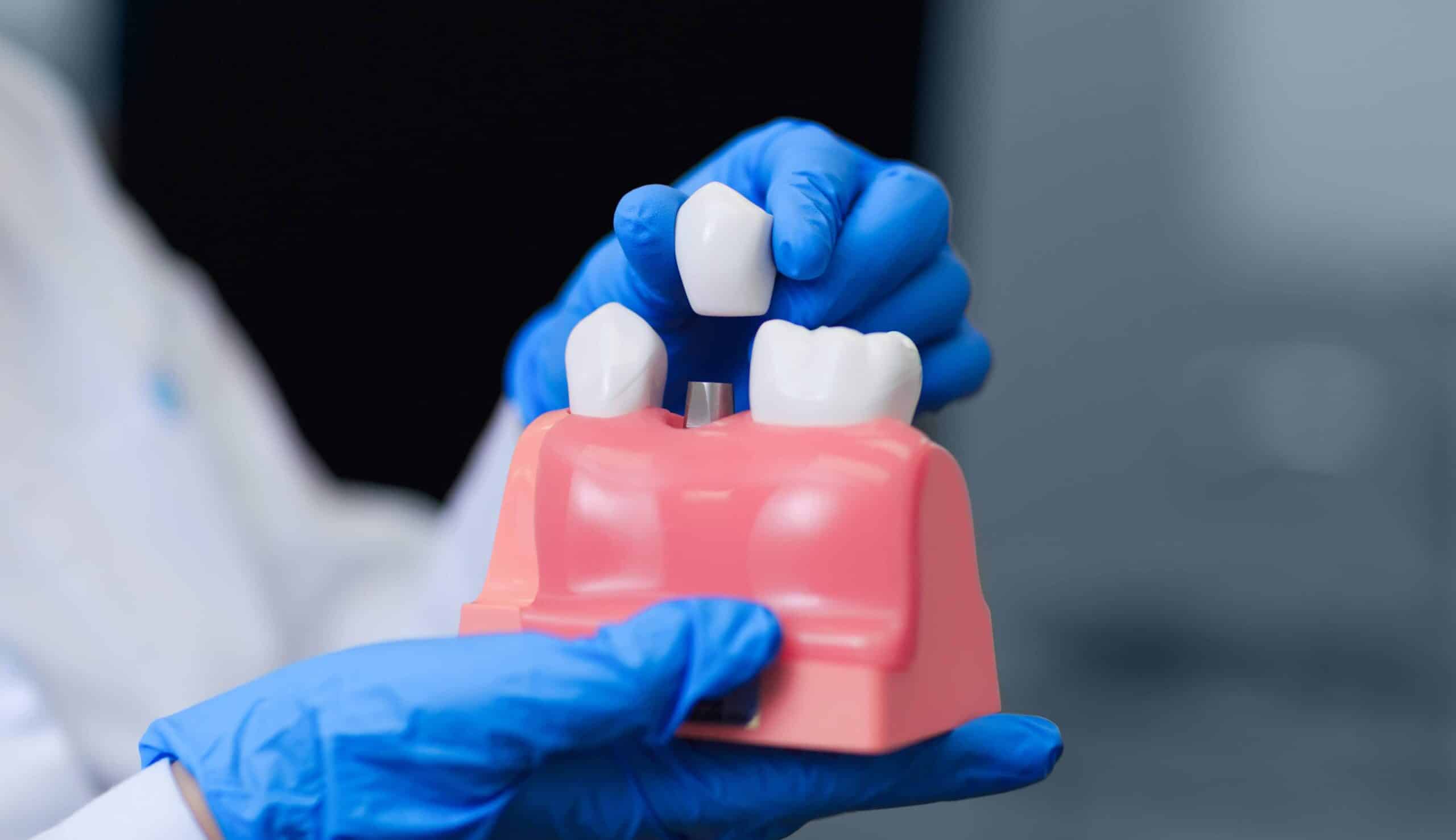 La pose d'un implant dentaire nécessite-t-elle une anesthésie ? | Clinique dentaire Sana Oris | Paris 8