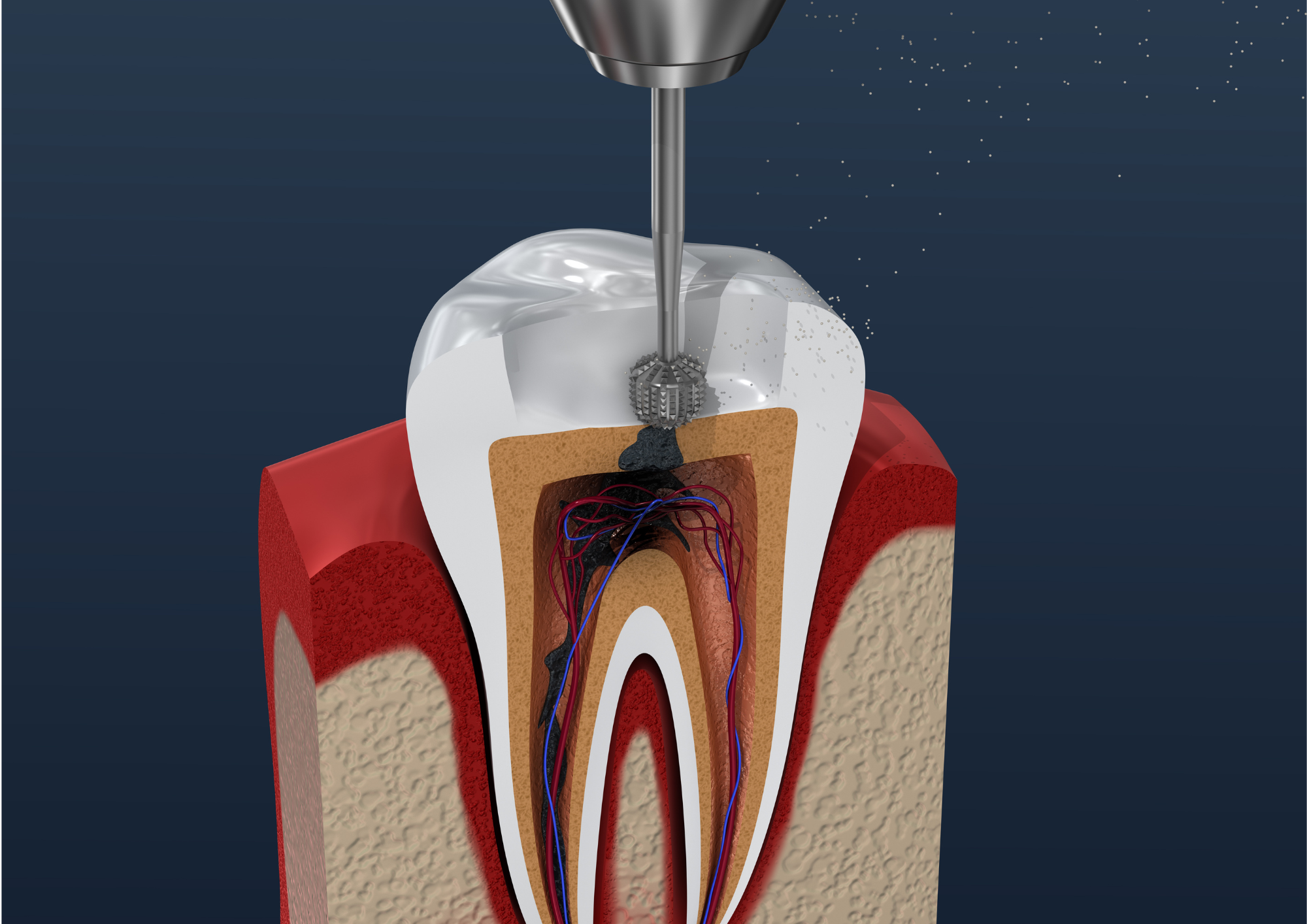 En quoi consiste le traitement endodontique chez Sana Oris ? | Clinique Dentaire Sana Oris | Paris