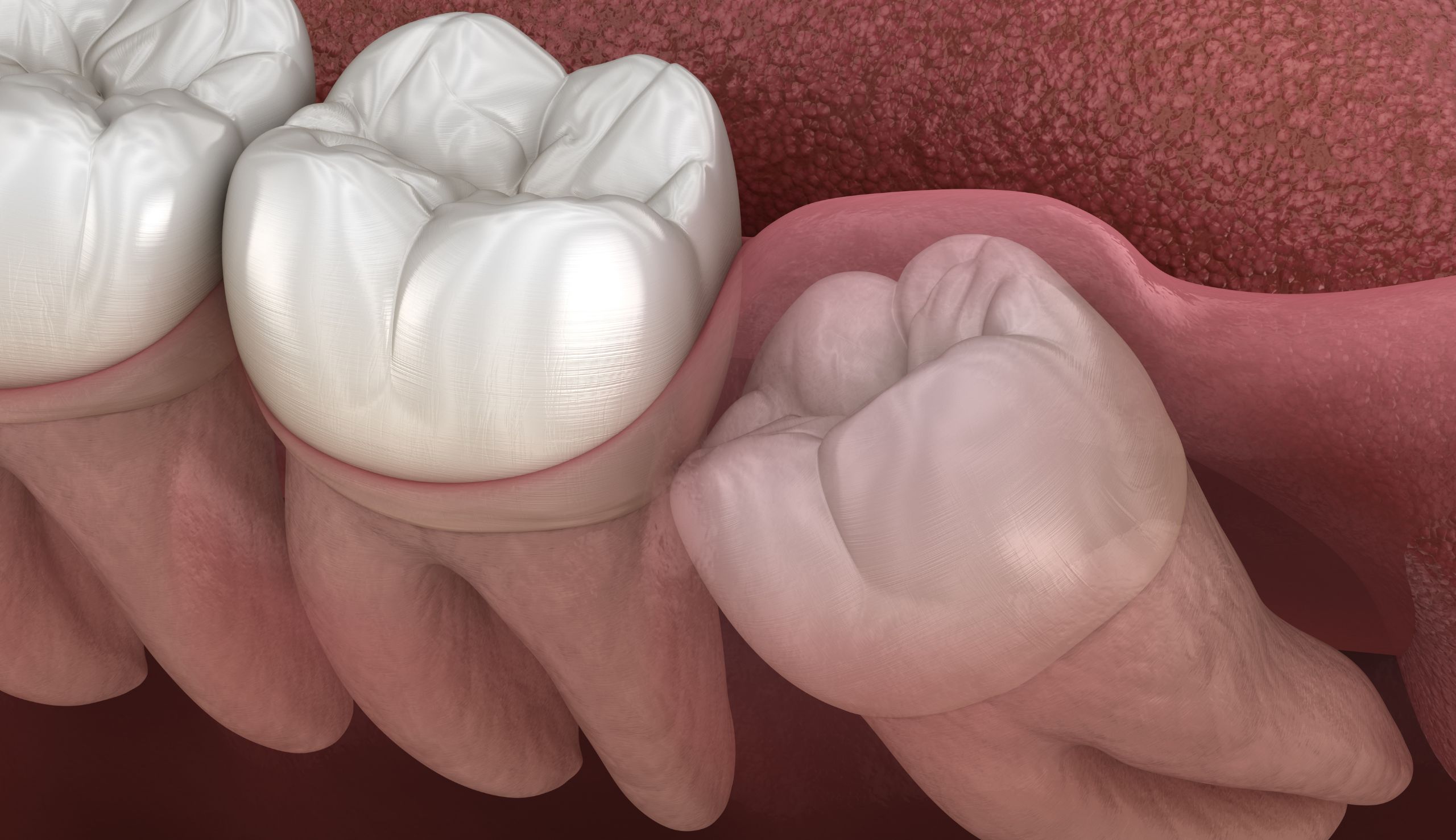 Les dents de sagesse : Pourquoi doivent-elles souvent être extraites ? | Clinique dentaire Sana Oris | Paris