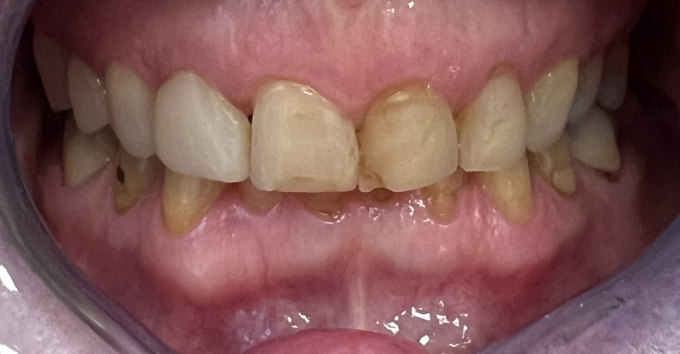 Limer les dent : le remodelage dentaire, Clinique Sana Oris