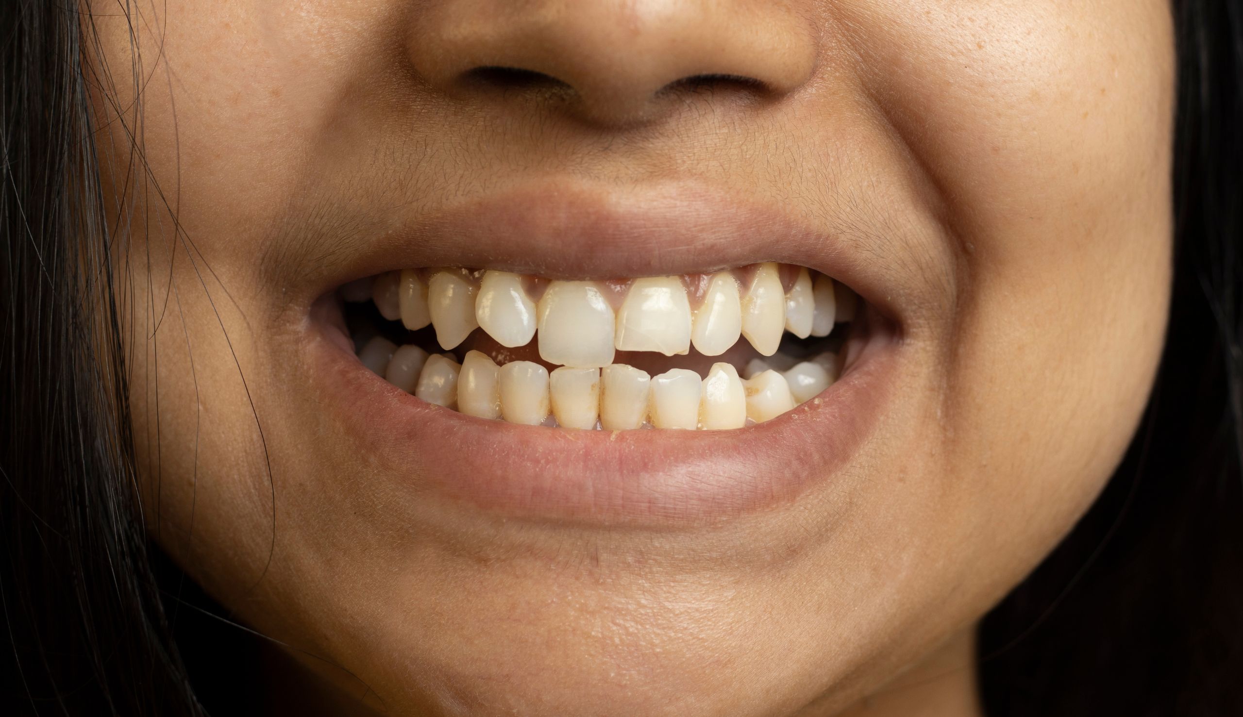 Quels soins pratiques t-on pour réparer une dent cassée ? | Clinique dentaire Sana Oris | Paris