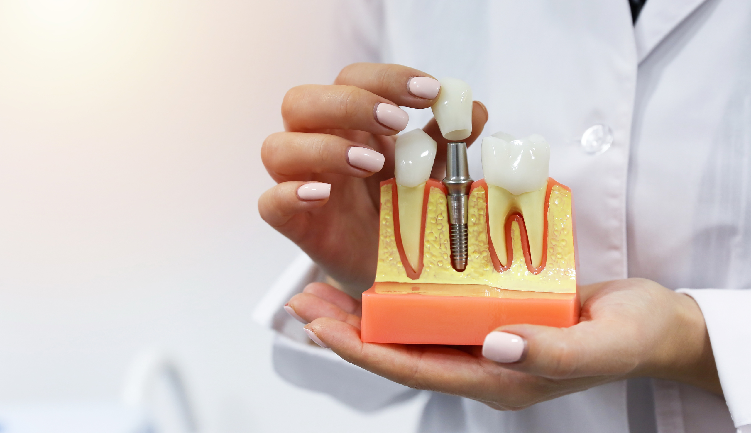 Tout savoir sur les implants dentaires | Clinique dentaire Sana Oris | Paris