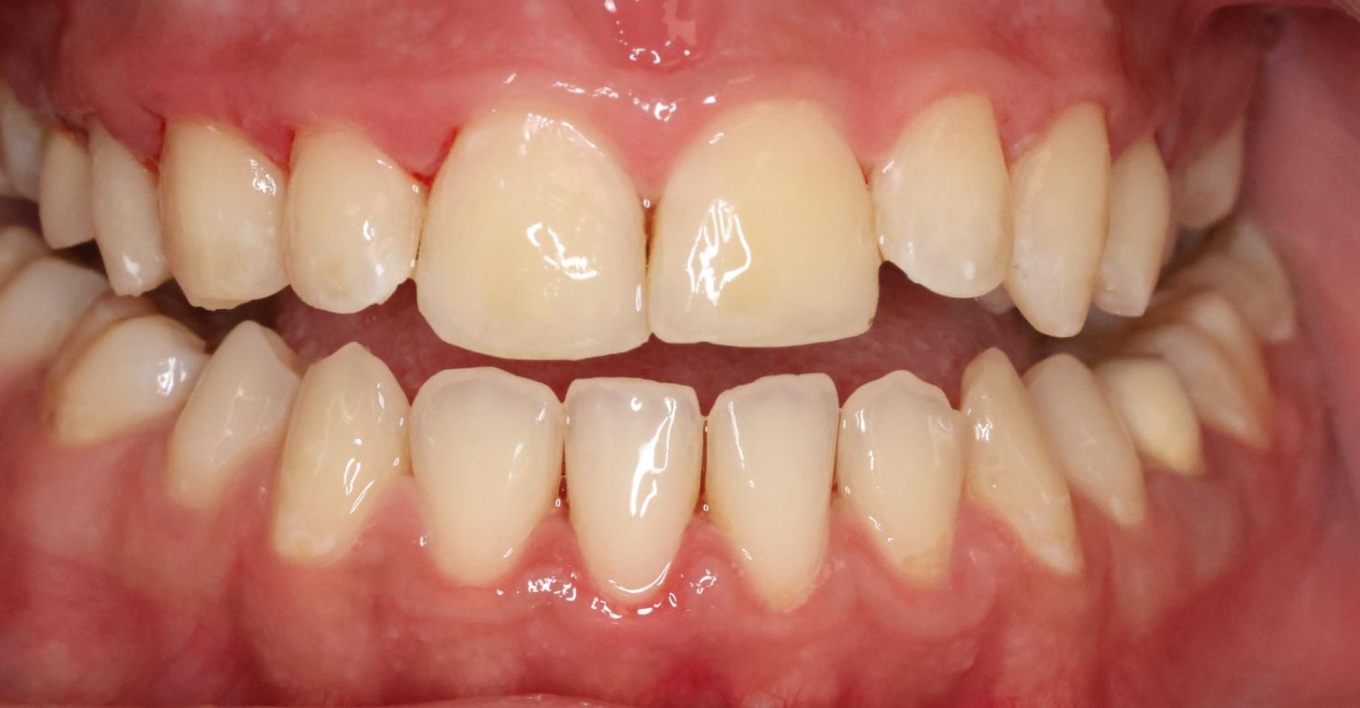 Photo apres d'un traitement de caries | Sana Oris | Paris