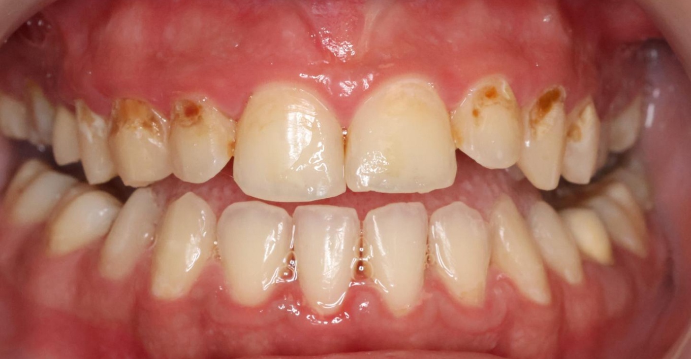 Photo avant d'un traitement de caries | Sana Oris | Paris