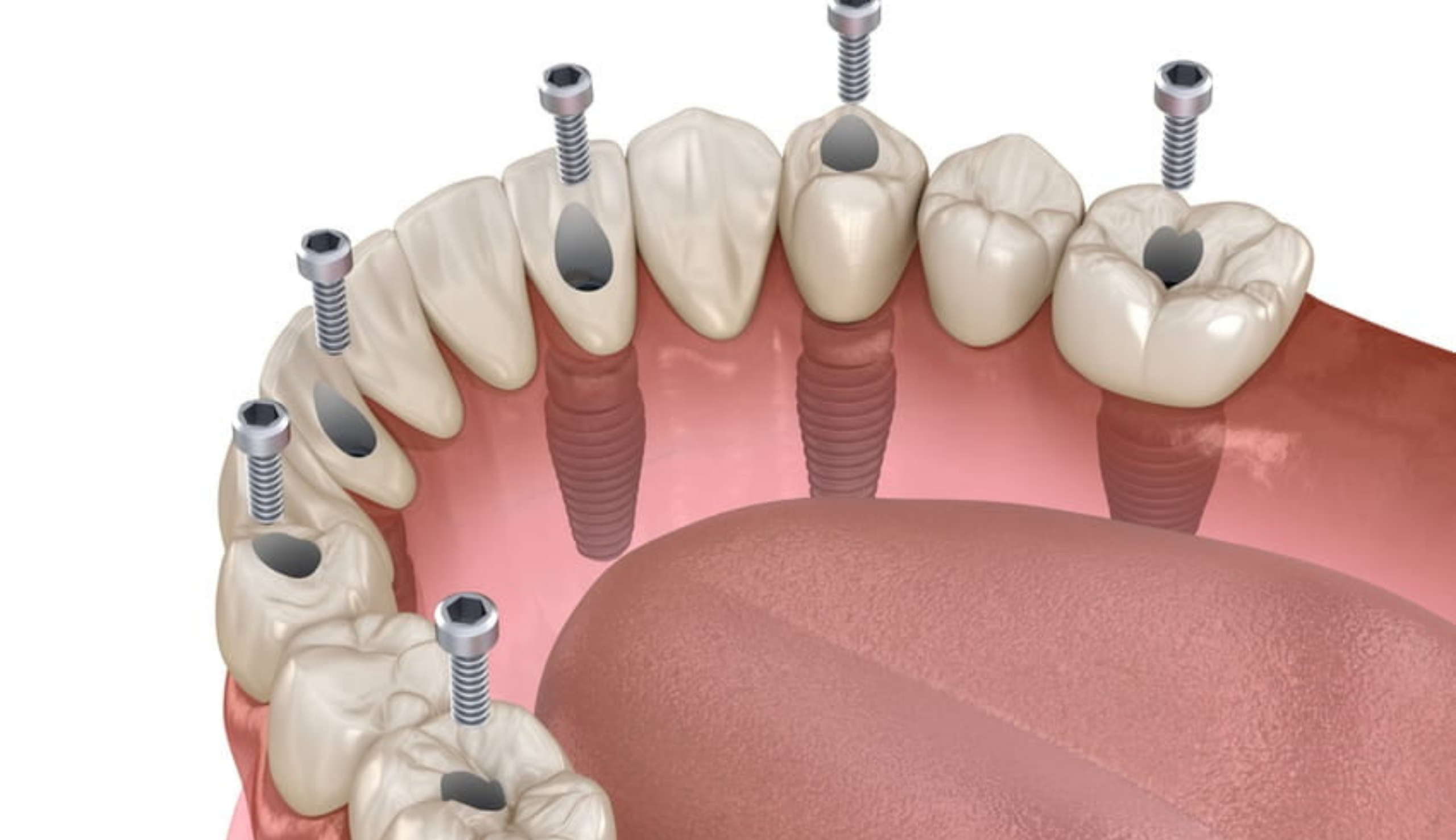 Retrouver votre sourire en 24h : Nos Implantologues experts en reconstruction complète | Clinique dentaire Sana Oris | Paris