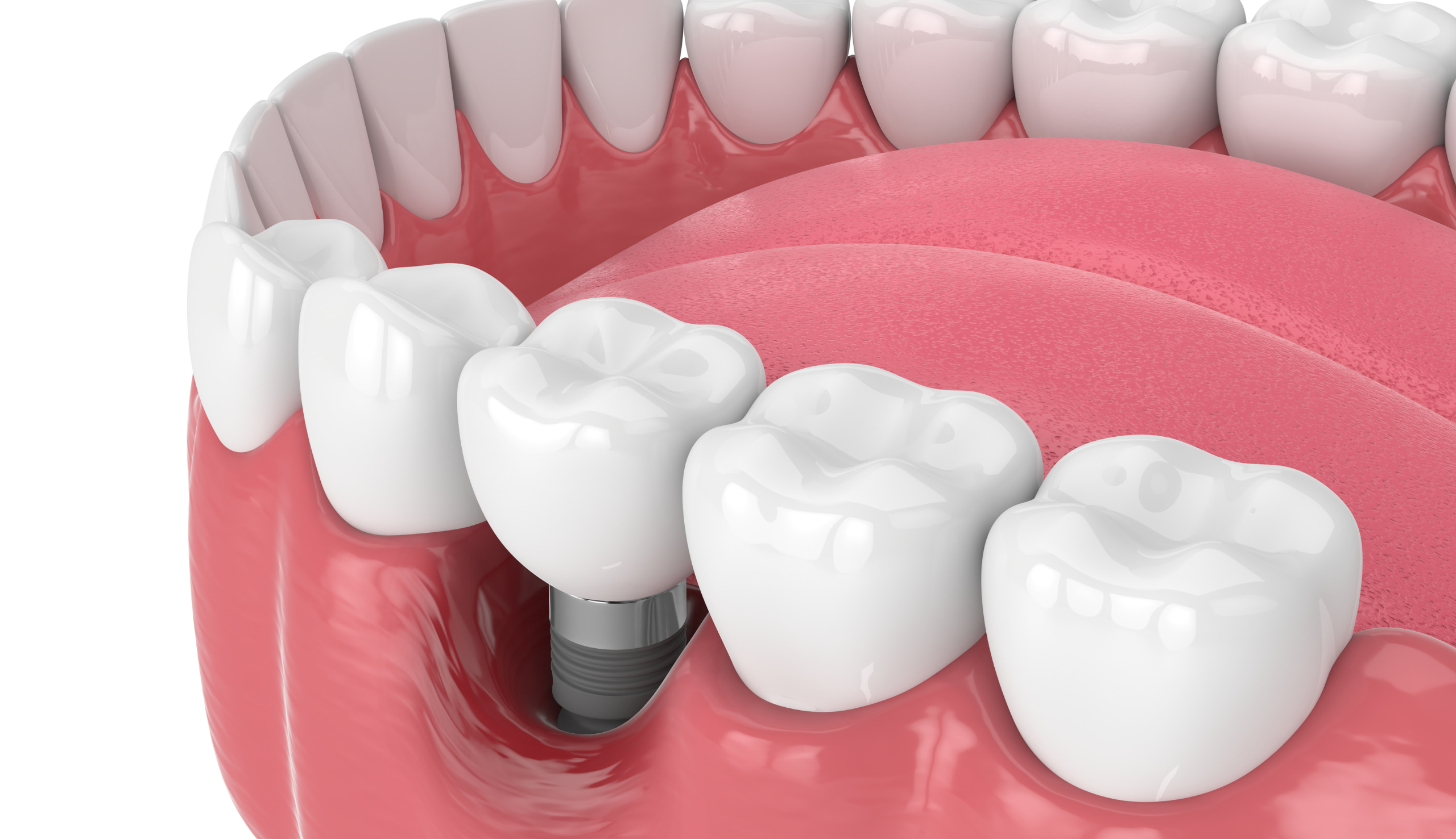 Qu'est ce qu'une péri-implantite ? | Clinique dentaire Sana Oris | Paris