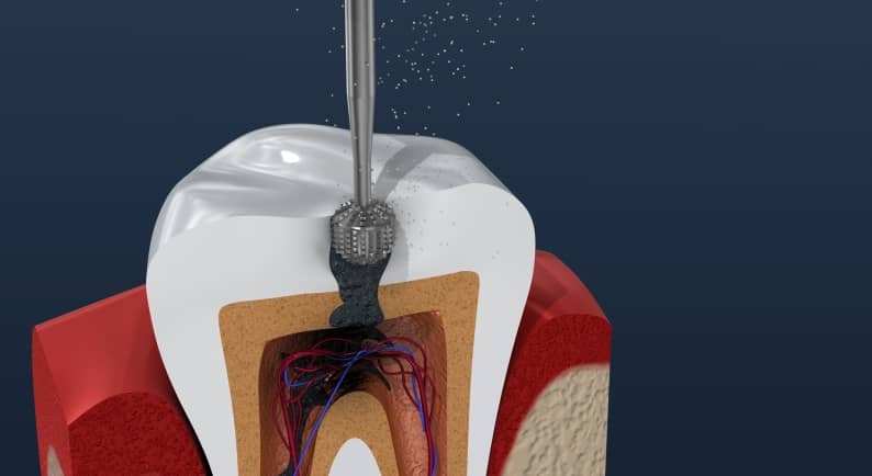 Pourquoi suivre son traitement endodontique au sein de la Clinique dentaire Sana Oris ? | Clinique dentaire Sana Oris | Paris