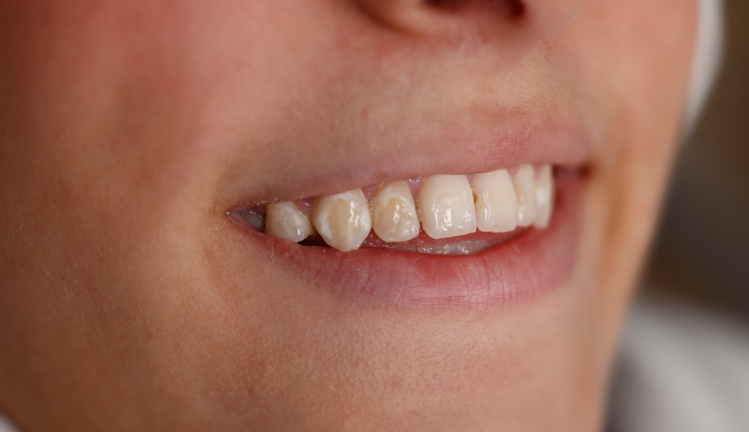 Le Traitement Icon : Révolutionner l'Esthétique dentaire en éliminant les taches blanches | Clinique Dentaire Sana Oris | Paris