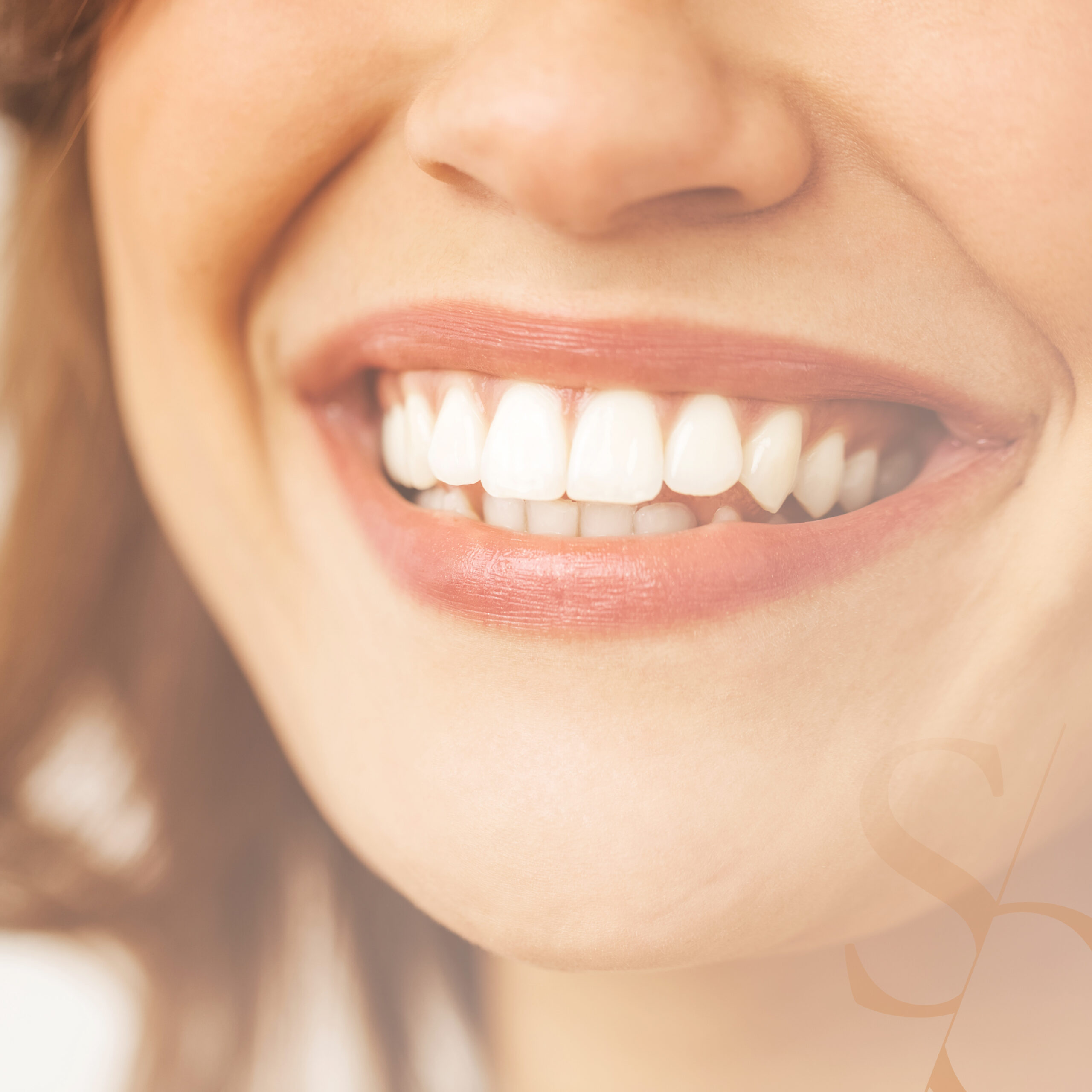 Contention fibrée sur dents antérieure | Sana Oris